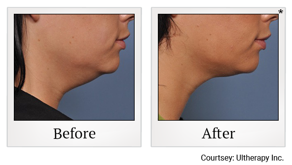 Before and After Photo 28 of Ultherapy treatment at SF Bay Cosmetic Surgery Medical Group in San Ramon