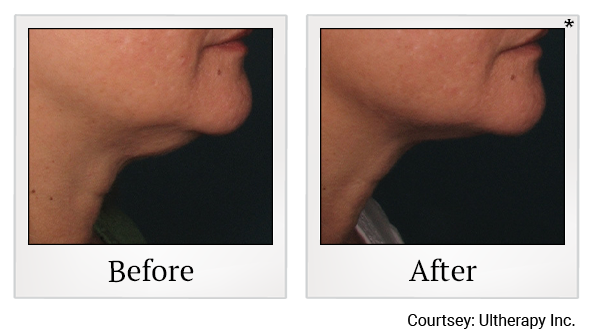Before and After Photo 29 of Ultherapy treatment at SF Bay Cosmetic Surgery Medical Group in San Ramon