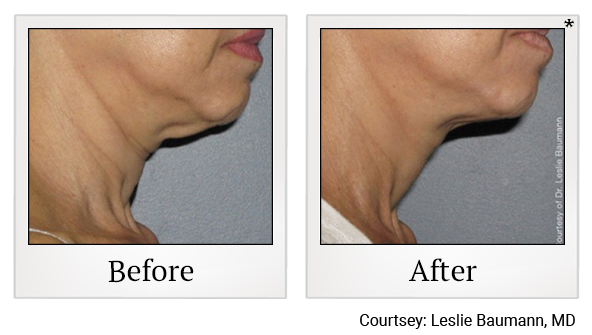 Before and After Photo 3 of Ultherapy treatment at SF Bay Cosmetic Surgery Medical Group in San Ramon