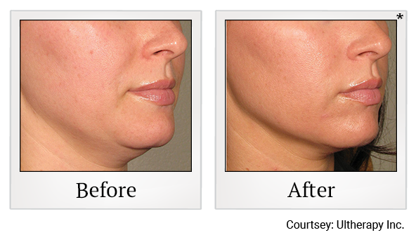 Before and After Photo 30 of Ultherapy treatment at SF Bay Cosmetic Surgery Medical Group in San Ramon