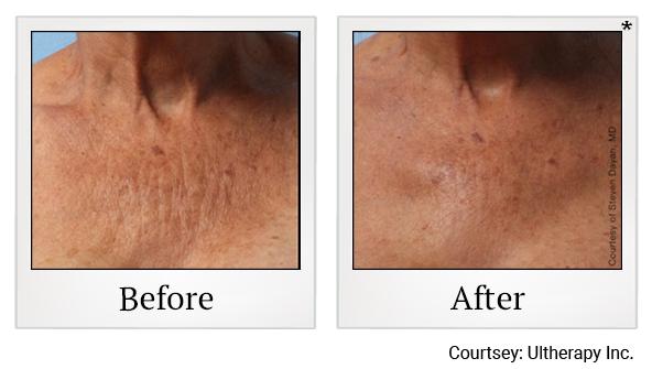 Before and After Photo 32 of Ultherapy treatment at SF Bay Cosmetic Surgery Medical Group in San Ramon