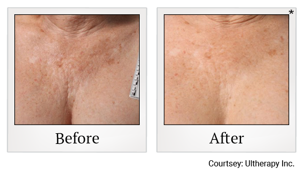 Before and After Photo 34 of Ultherapy treatment at SF Bay Cosmetic Surgery Medical Group in San Ramon