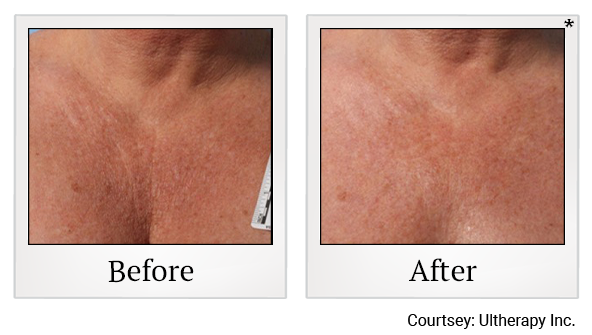 Before and After Photo 35 of Ultherapy treatment at SF Bay Cosmetic Surgery Medical Group in San Ramon