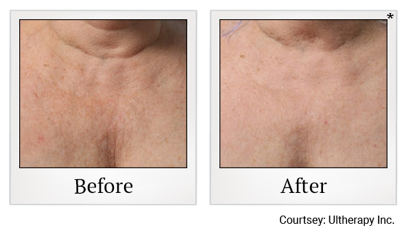 Before and After Photo 36 of Ultherapy treatment at SF Bay Cosmetic Surgery Medical Group in San Ramon