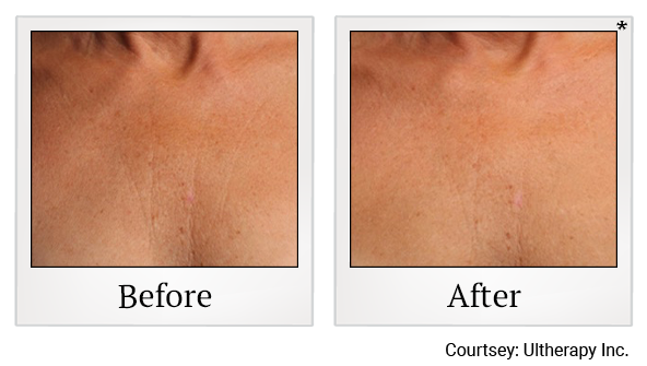 Before and After Photo 37 of Ultherapy treatment at SF Bay Cosmetic Surgery Medical Group in San Ramon
