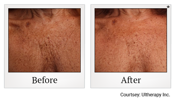 Before and After Photo 39 of Ultherapy treatment at SF Bay Cosmetic Surgery Medical Group in San Ramon