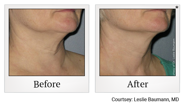 Before and After Photo 4 of Ultherapy treatment at SF Bay Cosmetic Surgery Medical Group in San Ramon