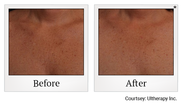 Before and After Photo 41 of Ultherapy treatment at SF Bay Cosmetic Surgery Medical Group in San Ramon