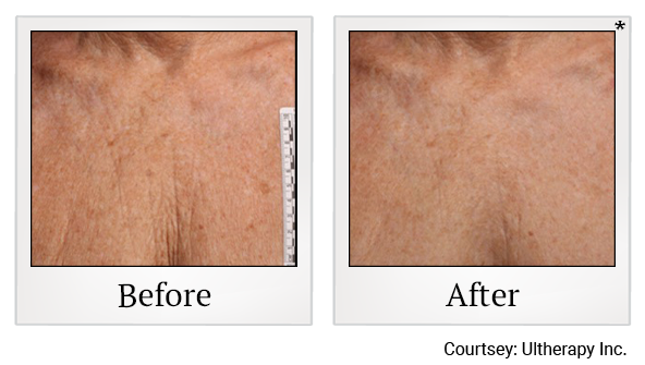 Before and After Photo 42 of Ultherapy treatment at SF Bay Cosmetic Surgery Medical Group in San Ramon