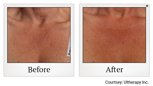 Before and After Photo 43 of Ultherapy treatment at SF Bay Cosmetic Surgery Medical Group in San Ramon