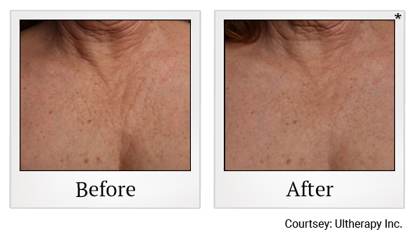 Before and After Photo 44 of Ultherapy treatment at SF Bay Cosmetic Surgery Medical Group in San Ramon