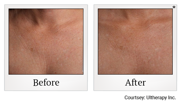Before and After Photo 45 of Ultherapy treatment at SF Bay Cosmetic Surgery Medical Group in San Ramon