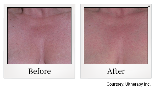 Before and After Photo 46 of Ultherapy treatment at SF Bay Cosmetic Surgery Medical Group in San Ramon