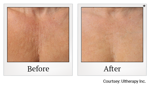 Before and After Photo 49 of Ultherapy treatment at SF Bay Cosmetic Surgery Medical Group in San Ramon