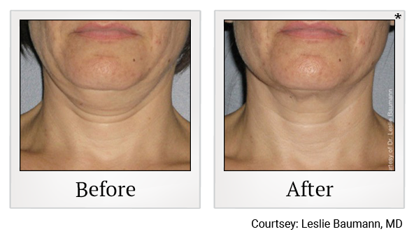 Before and After Photo 5 of Ultherapy treatment at SF Bay Cosmetic Surgery Medical Group in San Ramon