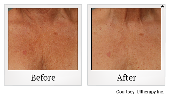 Before and After Photo 50 of Ultherapy treatment at SF Bay Cosmetic Surgery Medical Group in San Ramon