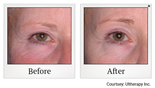 Before and After Photo 51 of Ultherapy treatment at SF Bay Cosmetic Surgery Medical Group in San Ramon