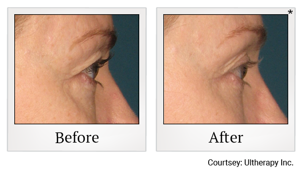 Before and After Photo 52 of Ultherapy treatment at SF Bay Cosmetic Surgery Medical Group in San Ramon