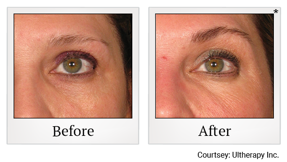 Before and After Photo 53 of Ultherapy treatment at SF Bay Cosmetic Surgery Medical Group in San Ramon