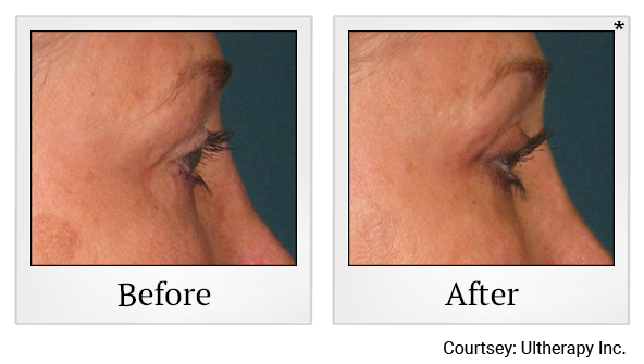 Before and After Photo 55 of Ultherapy treatment at SF Bay Cosmetic Surgery Medical Group in San Ramon