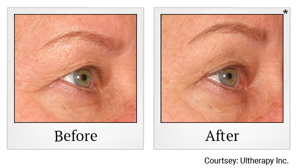 Before and After Photo 57 of Ultherapy treatment at SF Bay Cosmetic Surgery Medical Group in San Ramon