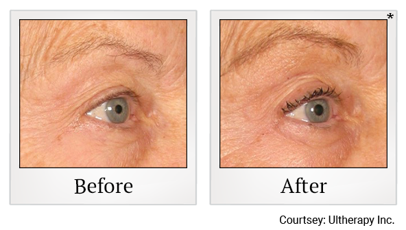 Before and After Photo 58 of Ultherapy treatment at SF Bay Cosmetic Surgery Medical Group in San Ramon