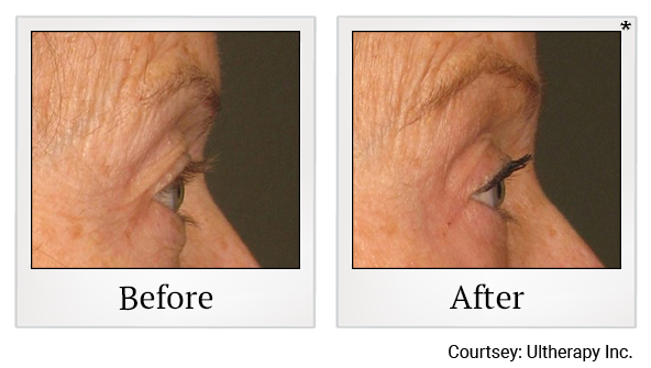 Before and After Photo 59 of Ultherapy treatment at SF Bay Cosmetic Surgery Medical Group in San Ramon