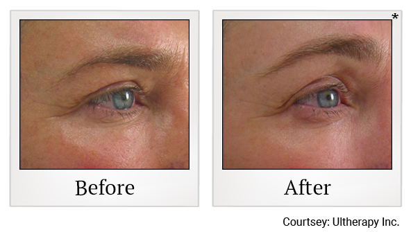 Before and After Photo 61 of Ultherapy treatment at SF Bay Cosmetic Surgery Medical Group in San Ramon