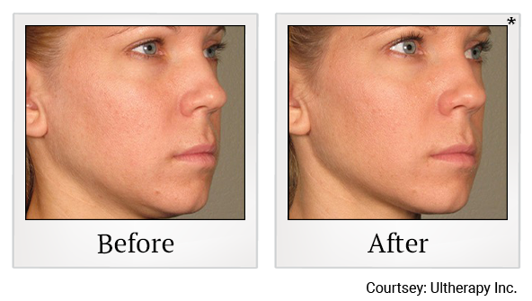 Before and After Photo 62 of Ultherapy treatment at SF Bay Cosmetic Surgery Medical Group in San Ramon