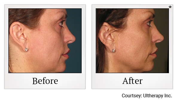 Before and After Photo 63 of Ultherapy treatment at SF Bay Cosmetic Surgery Medical Group in San Ramon