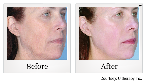 Before and After Photo 64 of Ultherapy treatment at SF Bay Cosmetic Surgery Medical Group in San Ramon