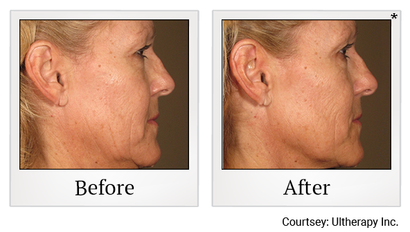 Before and After Photo 65 of Ultherapy treatment at SF Bay Cosmetic Surgery Medical Group in San Ramon