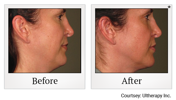 Before and After Photo 67 of Ultherapy treatment at SF Bay Cosmetic Surgery Medical Group in San Ramon