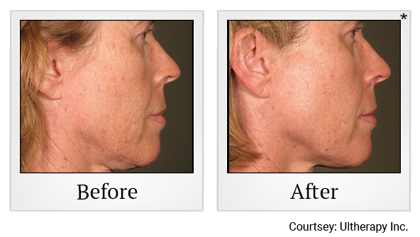 Before and After Photo 68 of Ultherapy treatment at SF Bay Cosmetic Surgery Medical Group in San Ramon