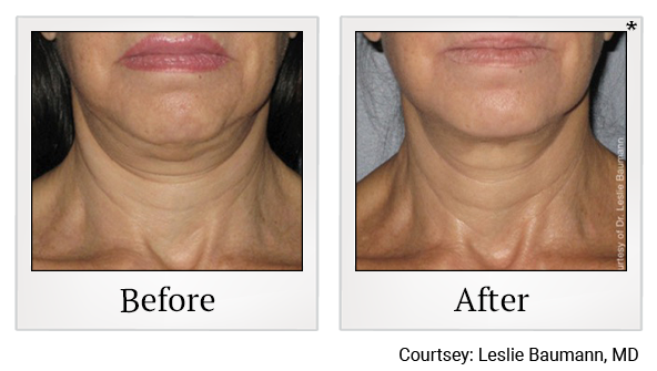 Before and After Photo 7 of Ultherapy treatment at SF Bay Cosmetic Surgery Medical Group in San Ramon