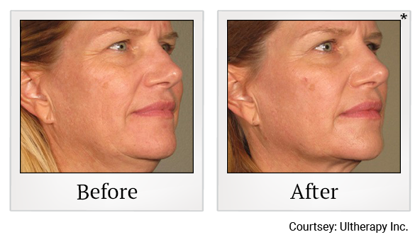 Before and After Photo 71 of Ultherapy treatment at SF Bay Cosmetic Surgery Medical Group in San Ramon