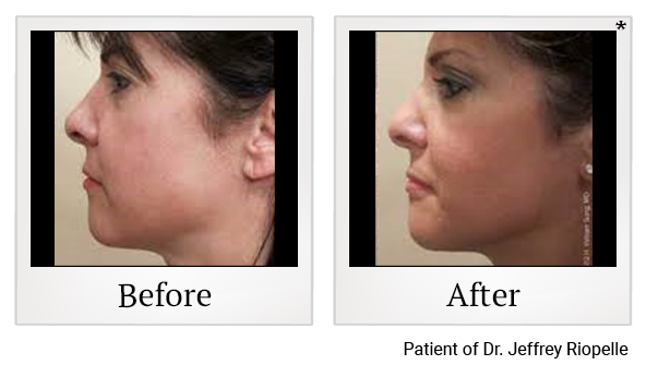 Before and After Photo 72 of Ultherapy treatment at SF Bay Cosmetic Surgery Medical Group in San Ramon