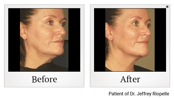 Before and After Photo 3 of Ultherapy® treatment at SF Bay Cosmetic Surgery Medical Group in San Ramon, Pleasanton, San Jose, and Oakland