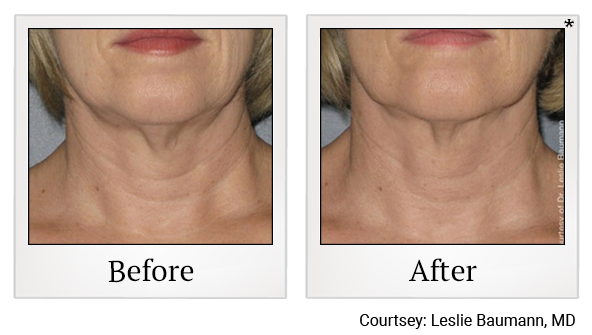 Before and After Photo 9 of Ultherapy treatment at SF Bay Cosmetic Surgery Medical Group in San Ramon