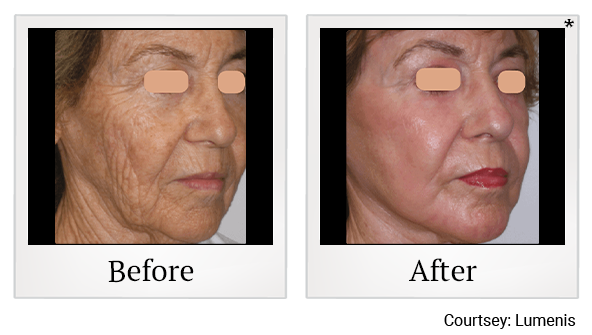 Before and After Photo 1 of UltraPulse® CO2 treatment at SF Bay Cosmetic Surgery Medical Group in San Ramon, Pleasanton, San Jose, and Oakland