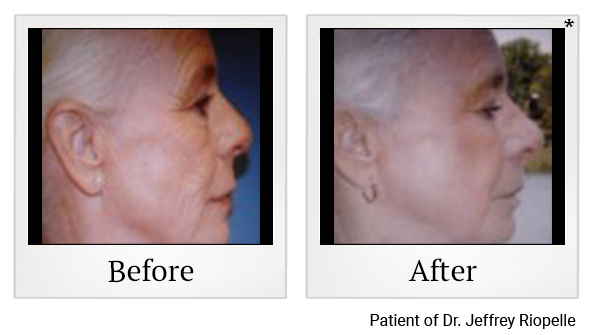Before and After Photo 10 of UltraPulse® CO2 treatment at SF Bay Cosmetic Surgery Medical Group in San Ramon, Pleasanton, San Jose, and Oakland