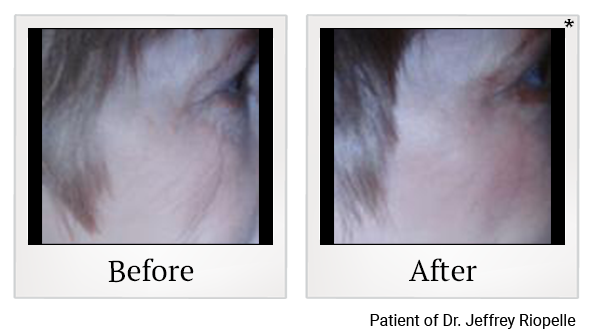 Before and After Photo 11 of UltraPulse® CO2 treatment at SF Bay Cosmetic Surgery Medical Group in San Ramon
