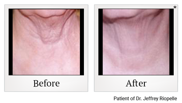 Before and After Photo 13 of UltraPulse® CO2 treatment at SF Bay Cosmetic Surgery Medical Group in San Ramon, Pleasanton, San Jose, and Oakland