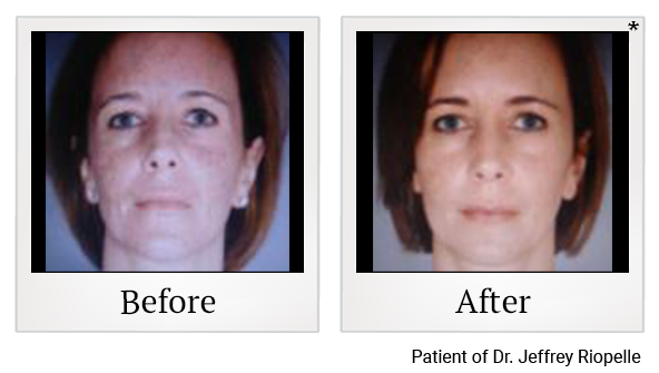 Before and After Photo 14 of UltraPulse® CO2 treatment at SF Bay Cosmetic Surgery Medical Group in San Ramon, Pleasanton, San Jose, and Oakland