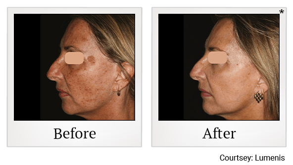 Before and After Photo 3 of UltraPulse® CO2 treatment at SF Bay Cosmetic Surgery Medical Group in San Ramon, Pleasanton, San Jose, and Oakland
