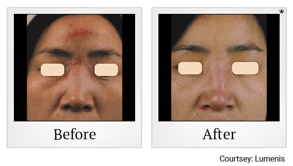 Before and After Photo 5 of UltraPulse® CO2 treatment at SF Bay Cosmetic Surgery Medical Group in San Ramon, Pleasanton, San Jose, and Oakland