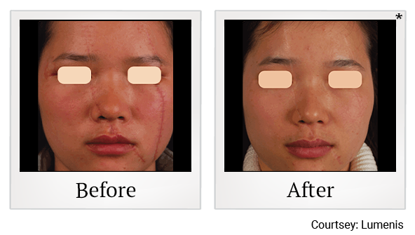 Before and After Photo 6 of UltraPulse® CO2 treatment at SF Bay Cosmetic Surgery Medical Group in San Ramon, Pleasanton, San Jose, and Oakland