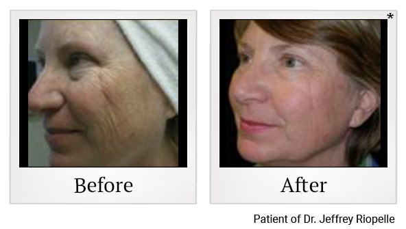 Before and After Photo 7 of UltraPulse® CO2 treatment at SF Bay Cosmetic Surgery Medical Group in San Ramon