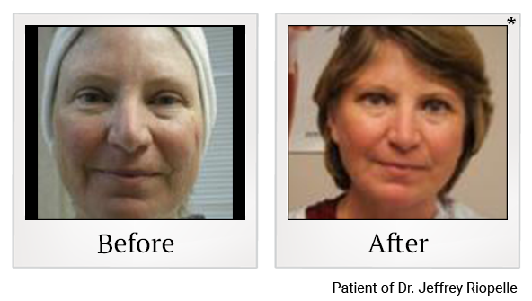 Before and After Photo 8 of UltraPulse® CO2 treatment at SF Bay Cosmetic Surgery Medical Group in San Ramon, Pleasanton, San Jose, and Oakland