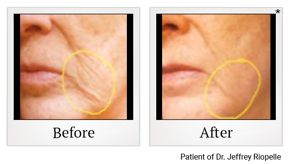 Before and After Photo 9 of UltraPulse® CO2 treatment at SF Bay Cosmetic Surgery Medical Group in San Ramon